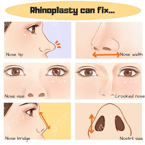 鼻修复流程一览图 鼻修复流程一览图