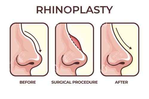 驼峰鼻矫正过程 驼峰鼻矫正过程