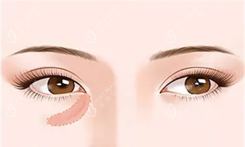 泪沟特写展示图 泪沟特写展示图