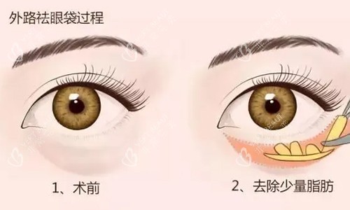 外切祛眼袋展示 外切祛眼袋展示
