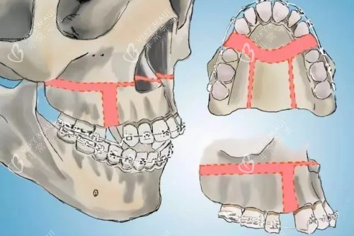 正颌手术示意图