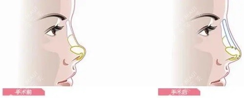 隆鼻前后对比图 隆鼻前后对比图
