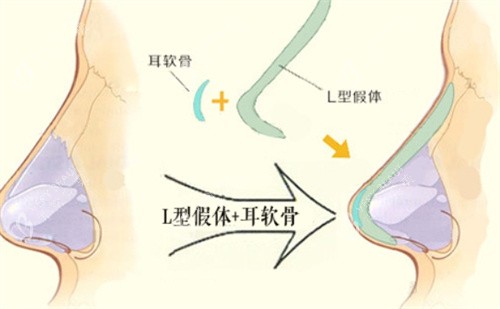 L形隆鼻假体 L形隆鼻假体
