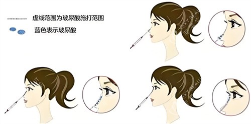 隆鼻玻尿酸部位图 隆鼻玻尿酸部位图