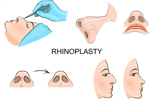 隆鼻过程图示 隆鼻过程图示