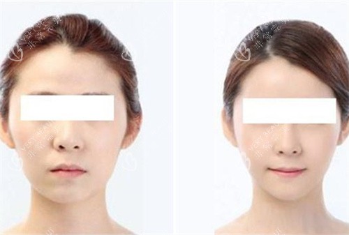 颧骨手术前后对比图