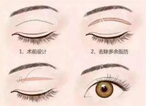 全切双眼皮卡通示意图 全切双眼皮卡通示意图