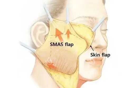 面部拉皮卡通示意图