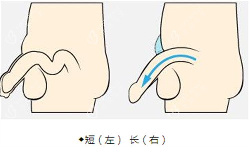 阴茎增长手术前后演示动画图 阴茎增长手术前后演示动画图
