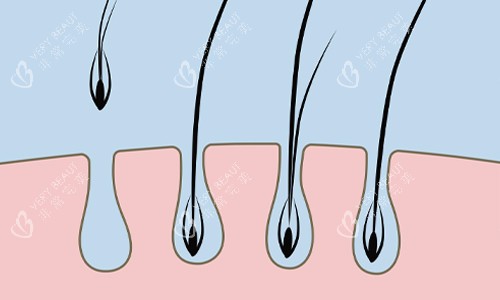 单毛囊植发展示