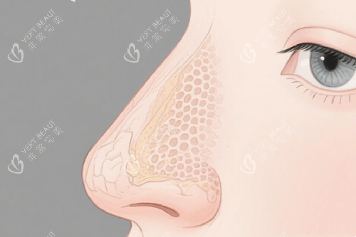 隆鼻动画示意图 隆鼻动画示意图