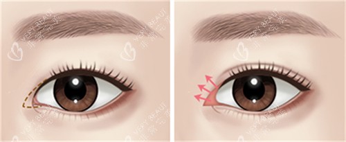 开内眼角的位置图解 开内眼角的位置图解