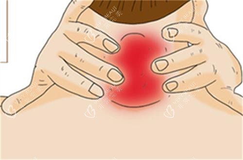 自测是否有富贵包的方法图解