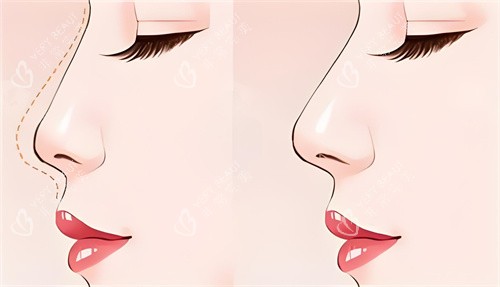 隆鼻前后对比动画图