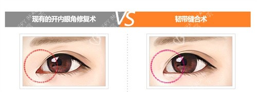 内眼角修复两种手术对比 内眼角修复两种手术对比