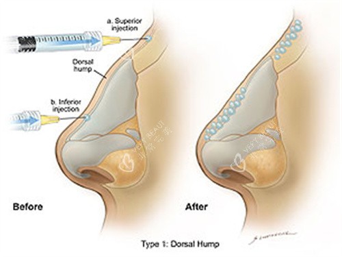 玻尿酸注射手术过程
