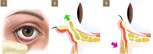 眼袋手术图解