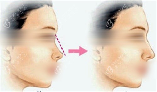 鼻背隆鼻填充前后对比图 鼻背隆鼻填充前后对比图