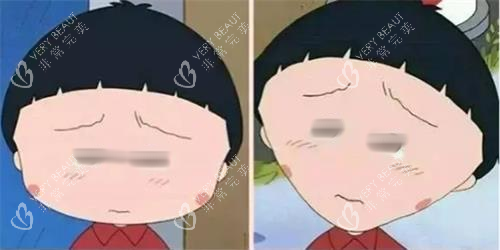 打针瘦脸前后明显对比图 打针瘦脸前后明显对比图