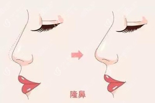 隆鼻对比示意图 隆鼻对比示意图