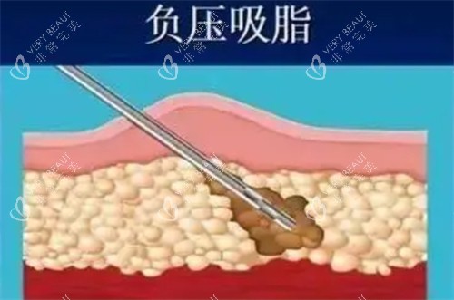 负压吸脂 负压吸脂