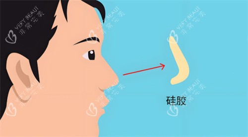 硅胶假体隆鼻 硅胶假体隆鼻