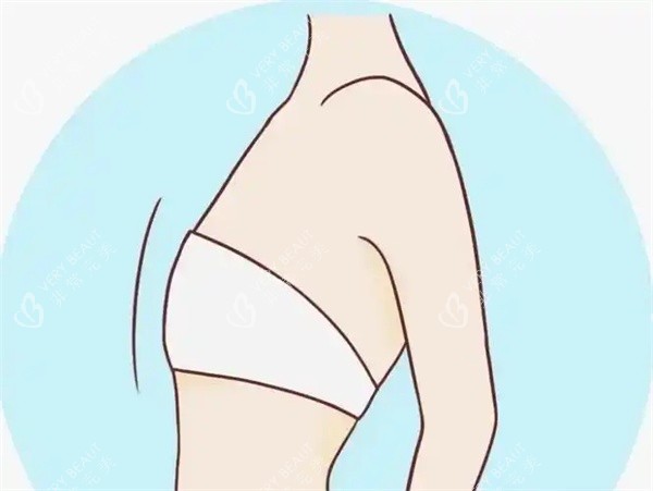 胸部缩小术 胸部缩小术