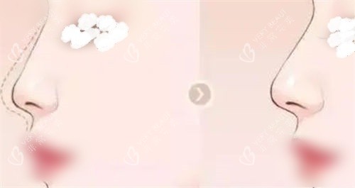 隆鼻鼻部鼻梁术前术后展示图 隆鼻鼻部鼻梁术前术后展示图