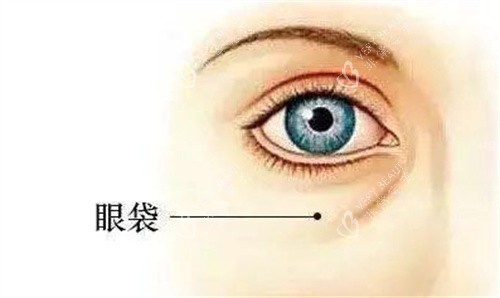 眼袋 眼袋