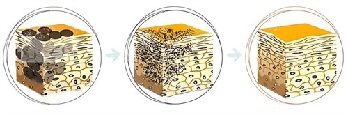 皮秒击碎色斑 皮秒击碎色斑