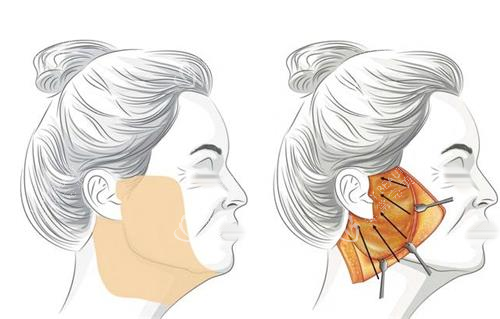 拉皮手术脂肪剥离示意图 拉皮手术脂肪剥离示意图