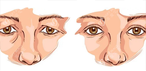 双眼皮修复前后 双眼皮修复前后