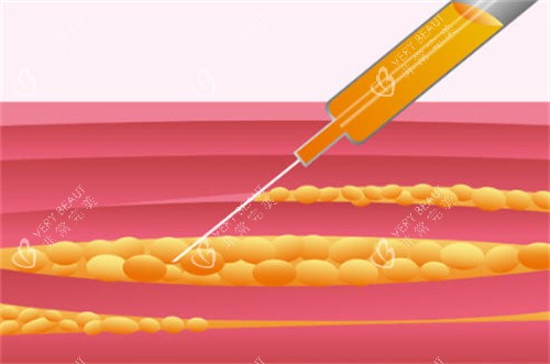 吸脂手术过程原理卡通图