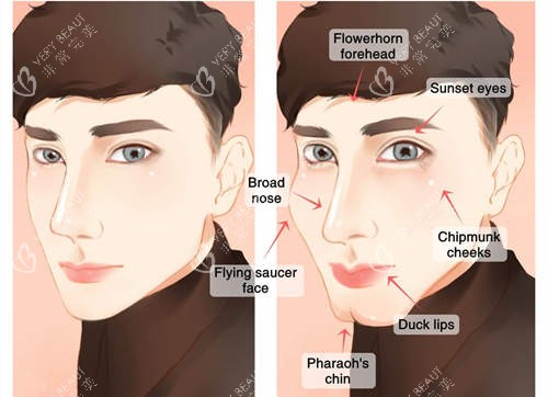 男性面部填充图 男性面部填充图