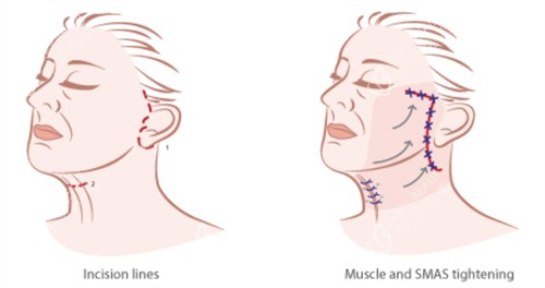 面部提升手术的对比和切口