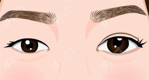 双眼皮手术术前术后对比卡通 双眼皮手术术前术后对比卡通