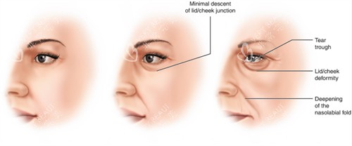 面部提升改善不同程度的面部老化