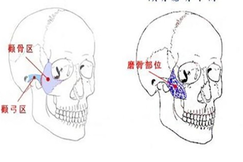 颧骨磨骨手术示意图 颧骨磨骨手术示意图