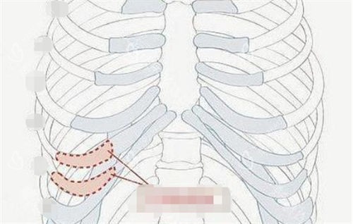 肋软骨隆鼻肋部位置展示图 肋软骨隆鼻肋部位置展示图