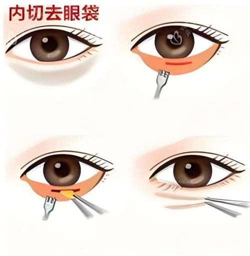 内切去眼袋演示动画图