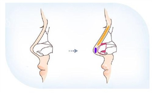 隆鼻手术 隆鼻手术