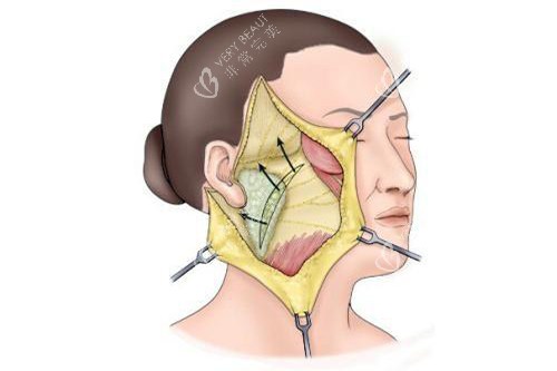 发际耳后切口拉皮手术示意图
