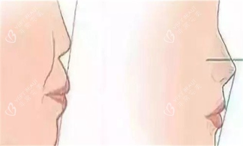 隆鼻前后侧面对比 隆鼻前后侧面对比