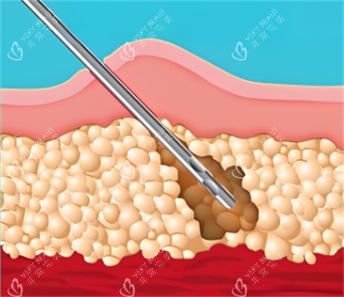 吸脂手术皮肤层 吸脂手术皮肤层