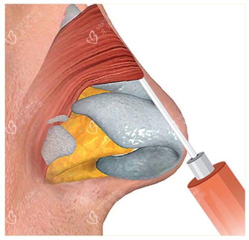 玻尿酸注射隆鼻过程图 玻尿酸注射隆鼻过程图
