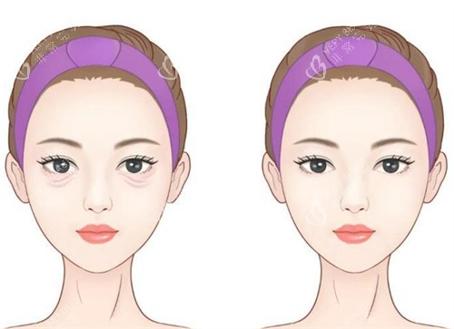 年轻祛眼袋前后对比