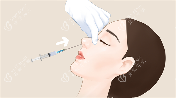 玻尿酸隆鼻术 玻尿酸隆鼻术