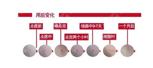 激光去痣后的成效 激光去痣后的成效