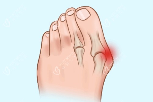 大脚骨疼痛卡通图