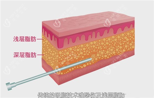 深层脂肪和浅层脂肪